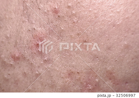 Close up nodular cystic acne skin Close up nodular cystic acne skin 32506997