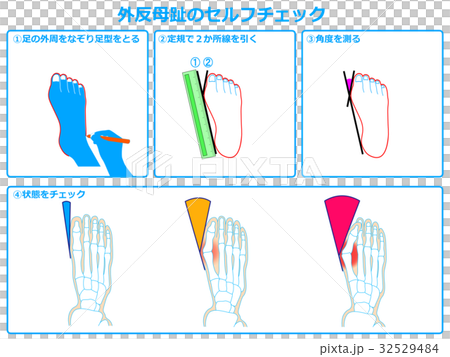 外反母趾のセルフチェック1（青色） 32529484