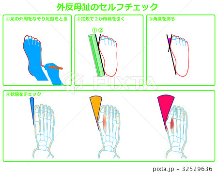 外反母趾のセルフチェック1（緑色・説明あり） 32529636