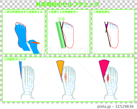 Hallux valgus self-check 1 (green, with description) Hallux valgus self-check 1 (green, with description) 32529636