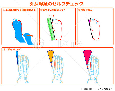 外反母趾のセルフチェック1 オレンジ色 説明あり のイラスト素材