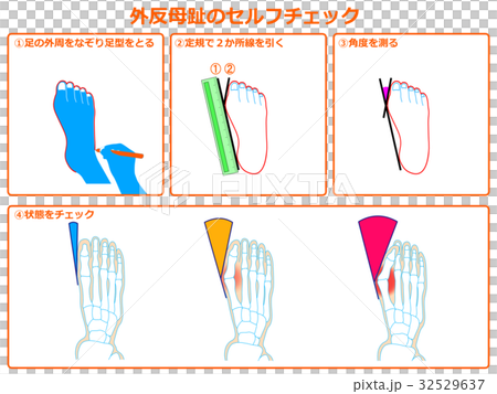 Hallux valgus self-check 1 (orange, with description) 32529637
