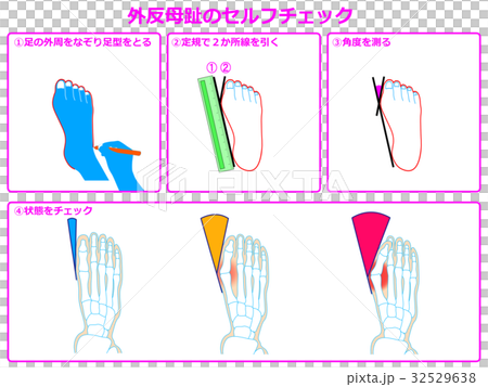 Hallux valgus self-check 1 (pink, with description) Hallux valgus self-check 1 (pink, with description) 32529638