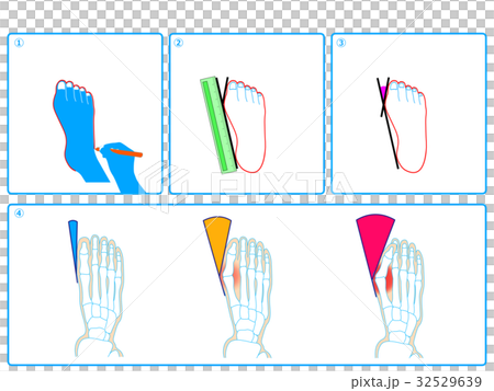 拇外翻自檢(藍色,無描述) 拇外翻自檢(藍色,無描述) 32529639