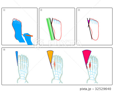 外反母趾のセルフチェック（灰色・説明なし） 32529640