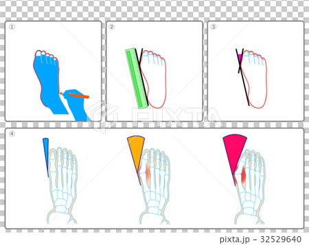 外反母趾のセルフチェック（灰色・説明なし） 32529640