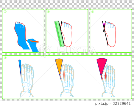 Hallux valgus self-check (green · no description) Hallux valgus self-check (green · no description) 32529641