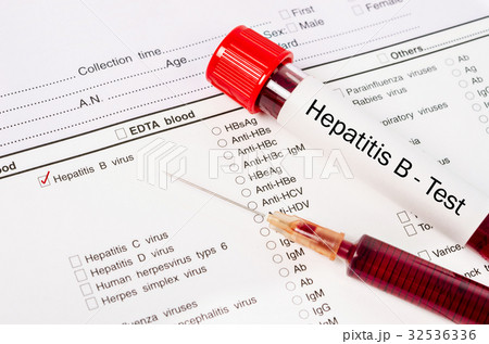 Sample blood in tube blood for Hepatitis B test. 32536336