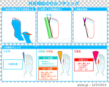 Self-check of hallux valgus 2 (blue, with explanation) 32553914