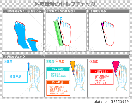 Self-check 2 of hallux valgus (gray · with explanation) Self-check 2 of hallux valgus (gray · with explanation) 32553919