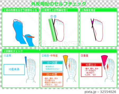 外反母趾のセルフチェック2 緑色 説明あり のイラスト素材 32554026 Pixta