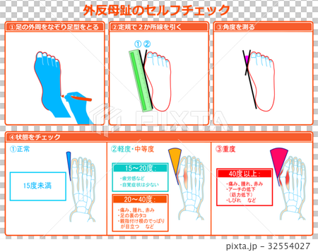 Self-check 2 of hallux valgus (with orange color and explanation) Self-check 2 of hallux valgus (with orange color and explanation) 32554027