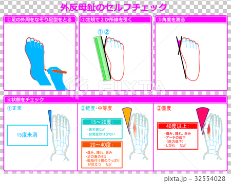 Self-check 2 of hallux valgus (with pink color and explanation) Self-check 2 of hallux valgus (with pink color and explanation) 32554028