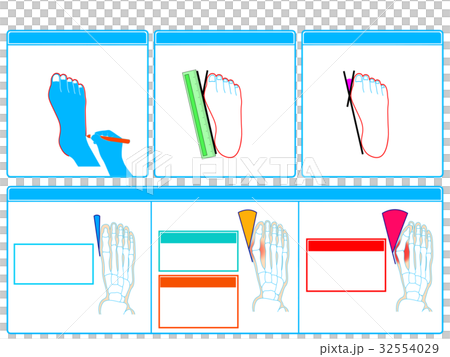 Self-check 2 of hallux valgus (blue, no explanation) Self-check 2 of hallux valgus (blue, no explanation) 32554029