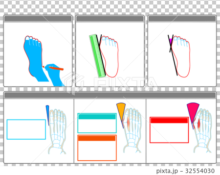 Self-check 2 of hallux valgus (gray · no explanation) 32554030