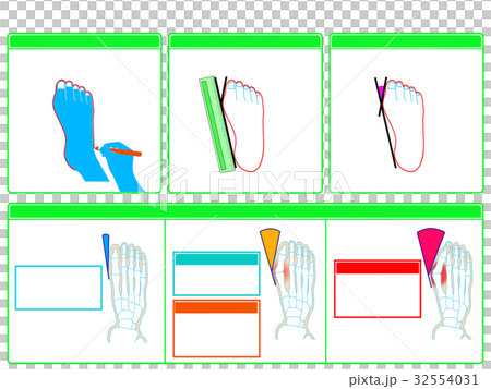 Self-check 2 of hallux valgus (green / no explanation) Self-check 2 of hallux valgus (green / no explanation) 32554031