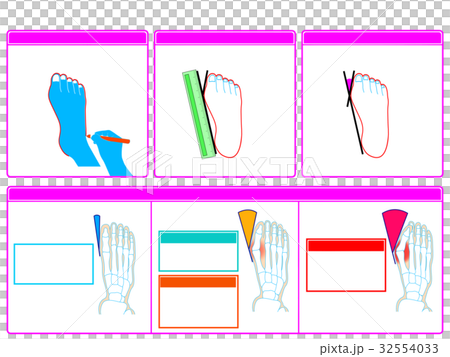 Self-check 2 of hallux valgus (pink color, no explanation) Self-check 2 of hallux valgus (pink color, no explanation) 32554033