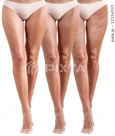 Woman legs before and after treatment. 32554535