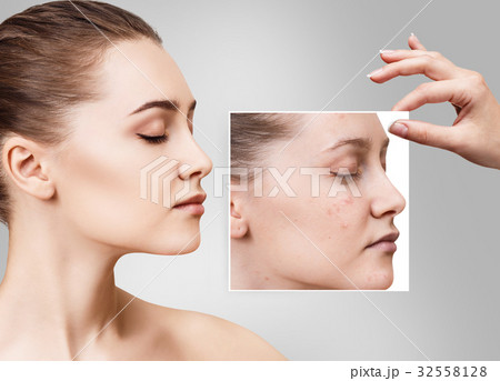 Woman shows photo with bad skin before treatment. 32558128