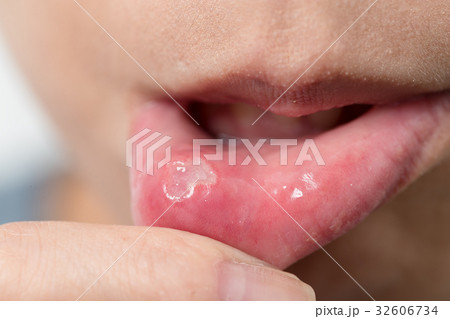 Woman suffer from aphtha Woman suffer from aphtha 32606734