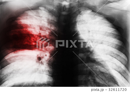 Lobar Pneumonia 32611720