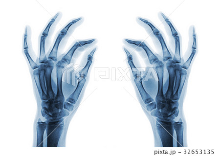 X-ray normal human hands on white background . X-ray normal human hands on white background . 32653135