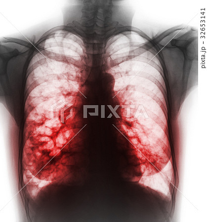 Bronchiectasis . Bronchiectasis . 32653141