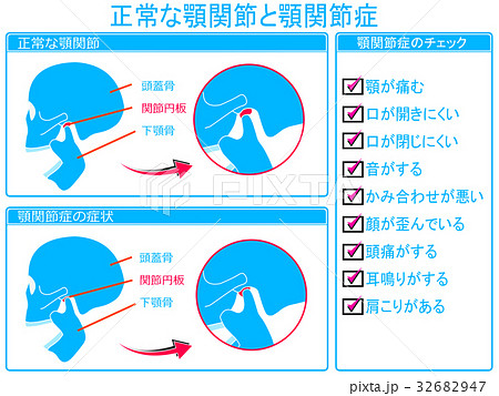 顎関節症のチェック（青色・文字あり） 32682947