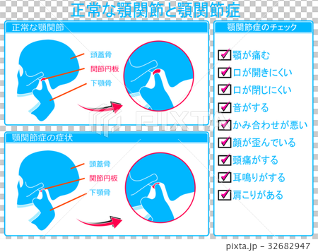顎関節症のチェック（青色・文字あり） 32682947