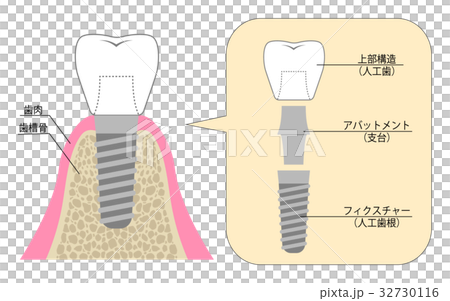 Explanation of Implant 32730116