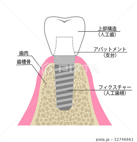 インプラント 説明図のイラスト素材