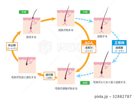 AGA 毛周期 イラスト素材 AGA 毛周期 イラスト素材 32882787