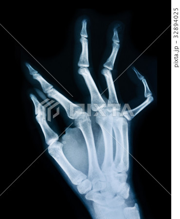 X ray of a hand. 32894025