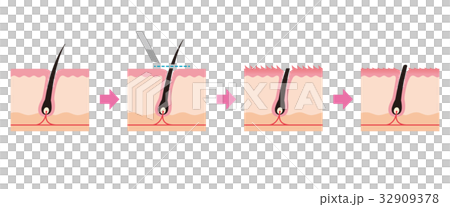 ムダ毛処理 カミソリ 毛の断面図のイラスト素材