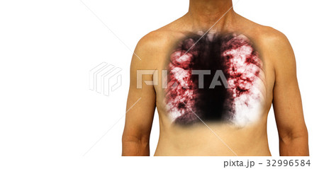Pulmonary tuberculosis . Pulmonary tuberculosis . 32996584