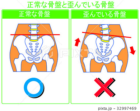 骨盤のゆがみ（正常・ゆがみ）の比較（緑色・言葉あり）　 32997469