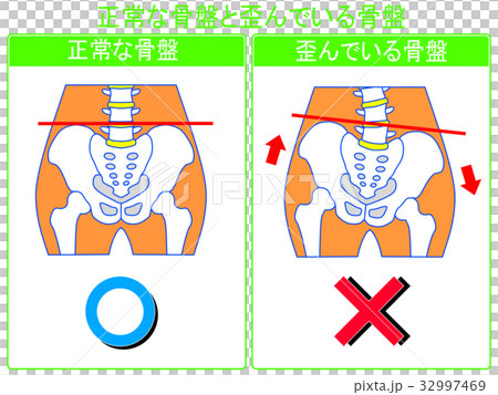骨盤のゆがみ（正常・ゆがみ）の比較（緑色・言葉あり）　 32997469