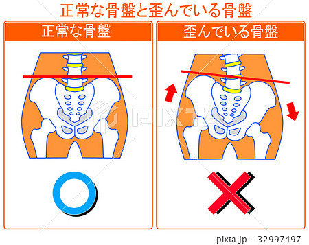 骨盤のゆがみ 正常 ゆがみ の比較 オレンジ色 言葉あり のイラスト素材