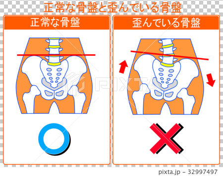 骨盤のゆがみ(正常・ゆがみ)の比較(オレンジ色・言葉あり) 骨盤のゆがみ(正常・ゆがみ)の比較(オレンジ色・言葉あり) 32997497