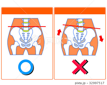 骨盤のゆがみ（正常・ゆがみ）の比較（オレンジ色・言葉なし）　 32997517