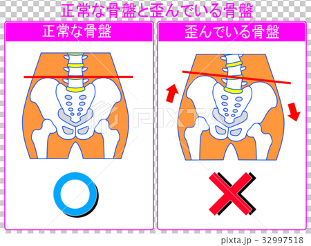 Comparison of pelvic distortion (normal / distorted) (gray-pink, with words) Comparison of pelvic distortion (normal / distorted) (gray-pink, with words) 32997518