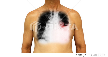 Lung cancer . Lung cancer . 33016587