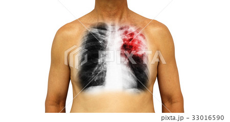 Pulmonary tuberculosis .  33016590