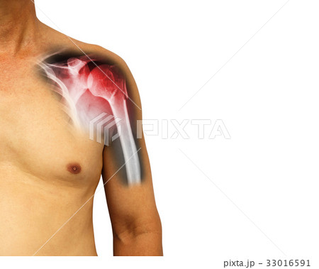 fracture at neck of humerus ( Arm bone ) 33016591