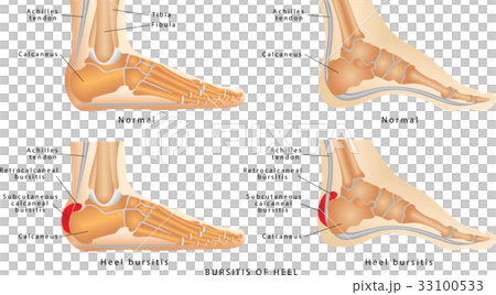Heel Bursitis 33100533