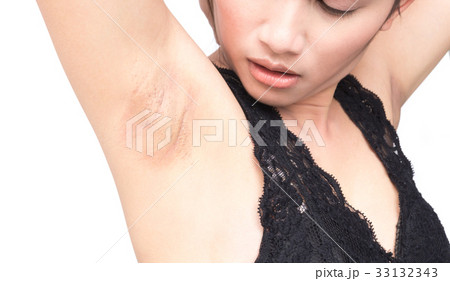 Women problem black armpit on white 33132343