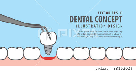 Banner Implant tooth install illustration vector 33162023