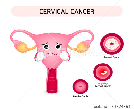 Cervical cancer diagram with sadness uterus. 33324361