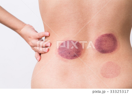 Woman having cupping therapy 33325317