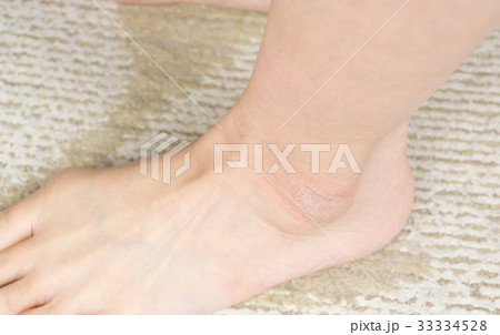 女性の足　くるぶしの角質 33334528